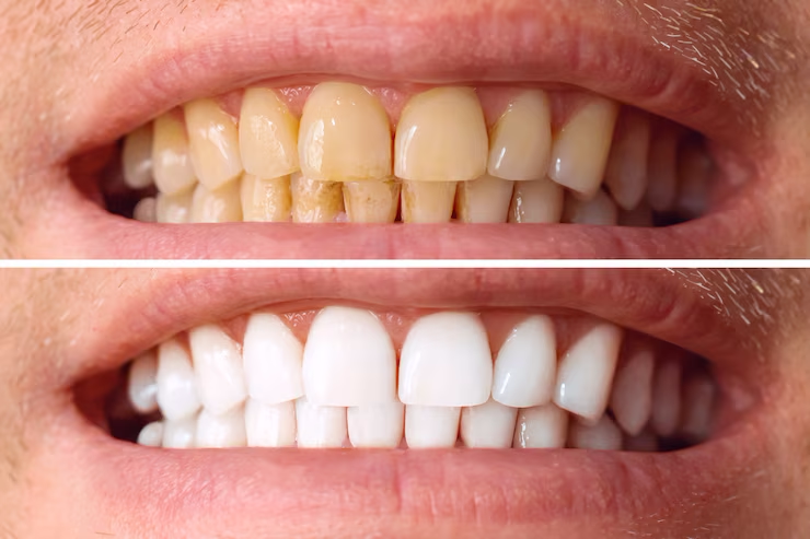 dentes-antes-e-depois-do-clareamento-sobre-fundo-branco-paciente-da-clinica-odontologica-a-imagem-simboliza-odontologia-de-higiene-bucal-estomatologia_168410-1798