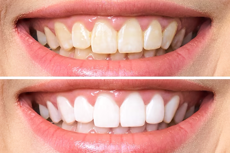 dentes-antes-e-depois-do-clareamento_168410-587