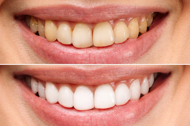 dentes-da-mulher-antes-e-depois-do-clareamento-sobre-fundo-branco_168410-1693